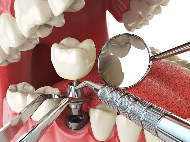 Best Emergency Denture Repair in Westmorland, CA